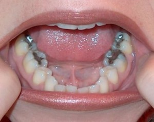Are Mercury Dental Fillings Safe